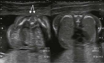 FIGURE 12-8, Splaying of the posterior elements in the lumbosacral region will be produced by angling too obliquely (arrows) when attempting to image axially.