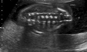 FIGURE 12-9, Coronal spine: the three ossification centres give a three line appearance: the inter-pedicular distance is essentially constant throughout the spine.