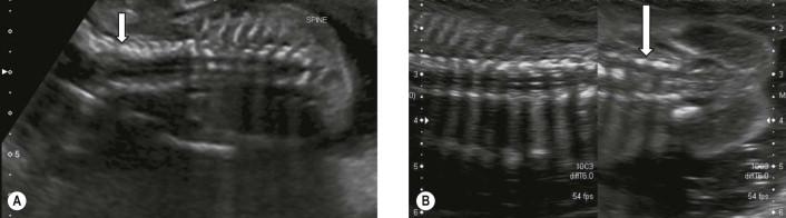 FIGURE 12-10, (A) There is a normal physiological widening in the upper spine at the cranio-occipital junction (A) and (B) at the lumbosacral spine (B) just prior to the normal tapering towards the sacrum.