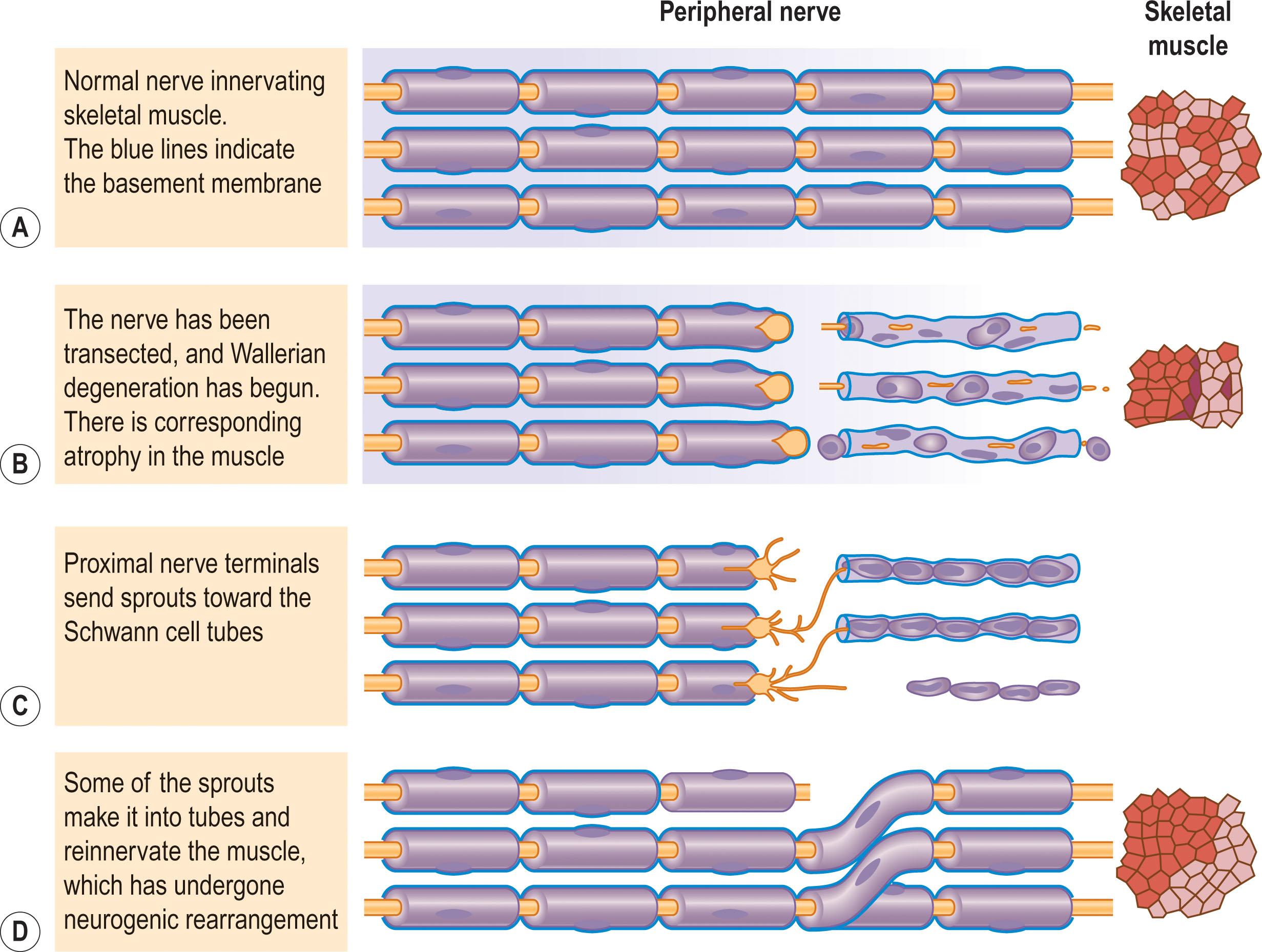 Figure 6.1.1, (A) A transection injury to a peripheral nerve results in degeneration of the axon distal to the site of transection (Wallerian degeneration). (B) The Schwann cells along this distal segment of the axon survive, upregulate, and produce nerve growth factor, while the axons of the proximal segment produce sprouts for distal regeneration. (C) When neural regeneration proceeds unimpeded, the axons will return to their distal target organ, with the creation of an in-continuity neuroma. (D) When neural regeneration is impeded by scar tissue from the injury, distal regeneration does not occur and an end-bulb neuroma forms.