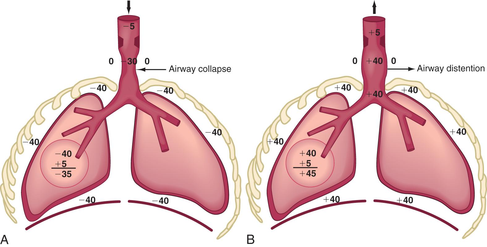 Fig. 400.1, A, In extrathoracic airway obstruction, the increased negative pressure during inspiration is transmitted up to the site of obstruction. This results in collapse of the extrathoracic airway below the site of obstruction, making the obstruction worse during inspiration. Note that the pressures are compared with the atmospheric pressure, which is traditionally represented as 0 cm. Terminal airway pressure is calculated as intrapleural pressure plus lung recoil pressure. Lung recoil pressure is arbitrarily chosen as 5 cm for the sake of simplicity. B, During expiration, the positive pressure below the site of obstruction results in distention of extrathoracic airway and amelioration of symptoms.