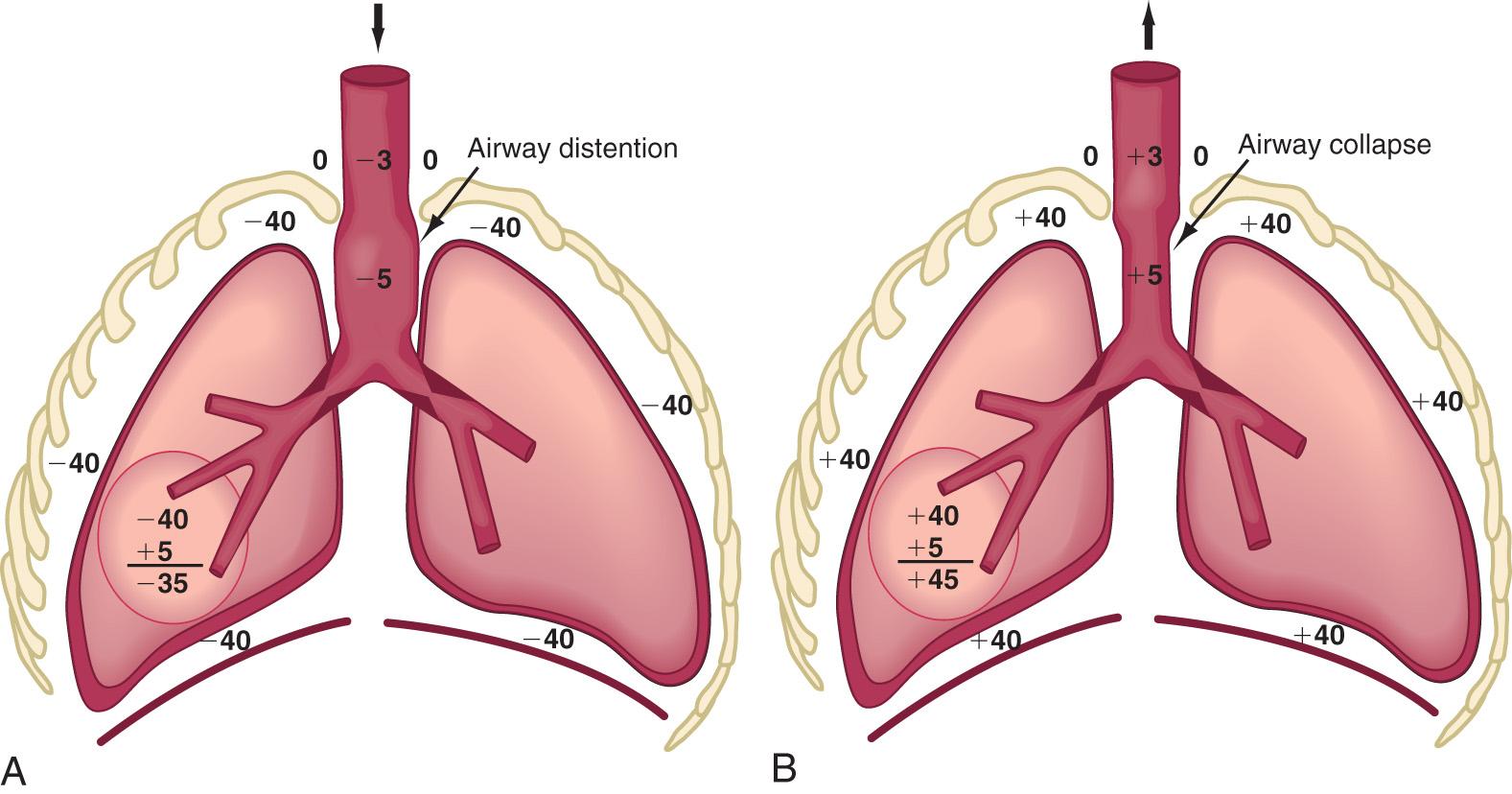 Fig. 400.2, A and B, In intrapulmonary airway obstruction, even a wider segment of intrathoracic airway is subjected to pressure changes compared with those observed in intrathoracic-extrapulmonary airway obstruction. Such lesions are associated with marked increase in airway obstruction during expiration.