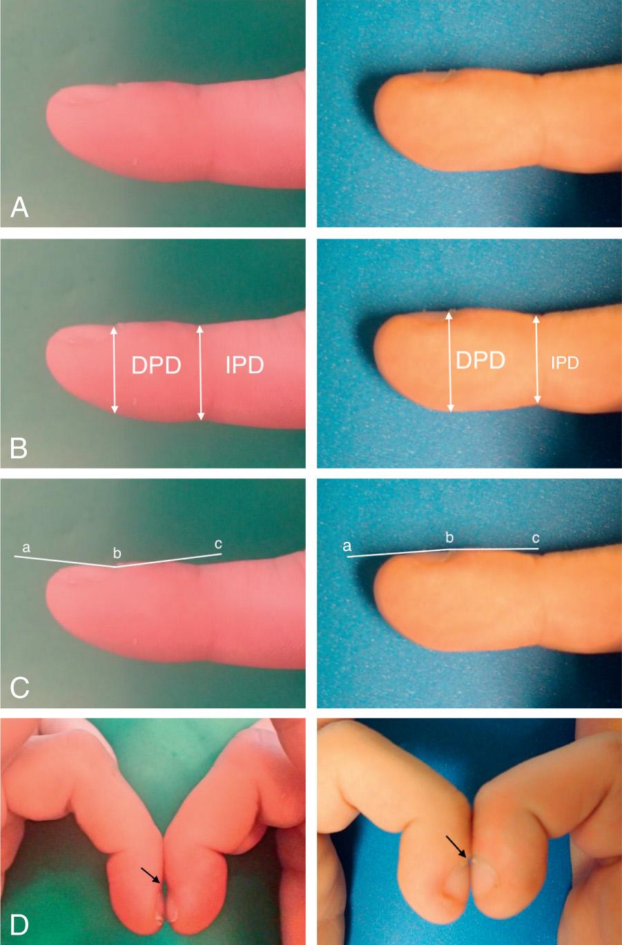 Fig. 400.3, A, Normal and clubbed finger viewed in profile. B, The normal finger demonstrates a distal phalangeal finger depth (DPD) /interphalangeal finger depth (IPD) ratio <1. The clubbed finger demonstrates a DPD/IPD ratio >1. C, The normal finger on the left demonstrates a normal profile (abc) with angle less than 180 degrees. The clubbed finger demonstrates a profile angle >180 degrees. D, Schamroth sign is demonstrated in the clubbed finger with the loss of diamond shape window in between finger beds (arrow) that is demonstrated in the normal finger.