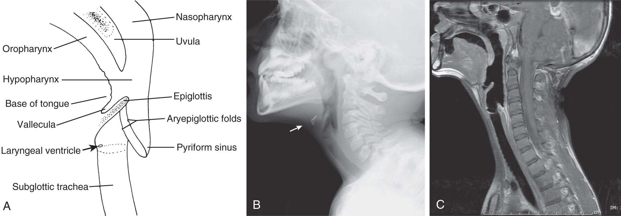 Fig. 400.7, A, Diagram depicting the normal anatomy of the upper airway. B, Corresponding lateral radiograph of the neck soft tissues. C, Sagittal T1-weighted magnetic resonance image. The hyoid bone “points to” the epiglottis on the radiograph (arrow) .