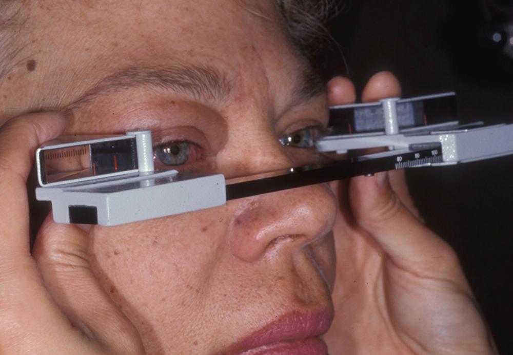 Figure 14.1, Hertel exophthalmometer measures the distance from the lateral canthal angle to the anterior surface of the cornea.