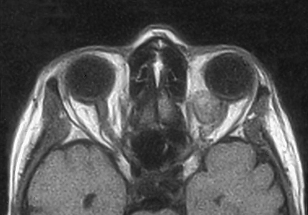 Figure 14.11, MRI scan of intraconal mass, medial to the optic nerve, apparently attached to the nerve. Proven by biopsy to be a metastatic cutaneous melanoma. Smooth shape is not characteristic of most metastatic tumors, which are infiltrative in nature.