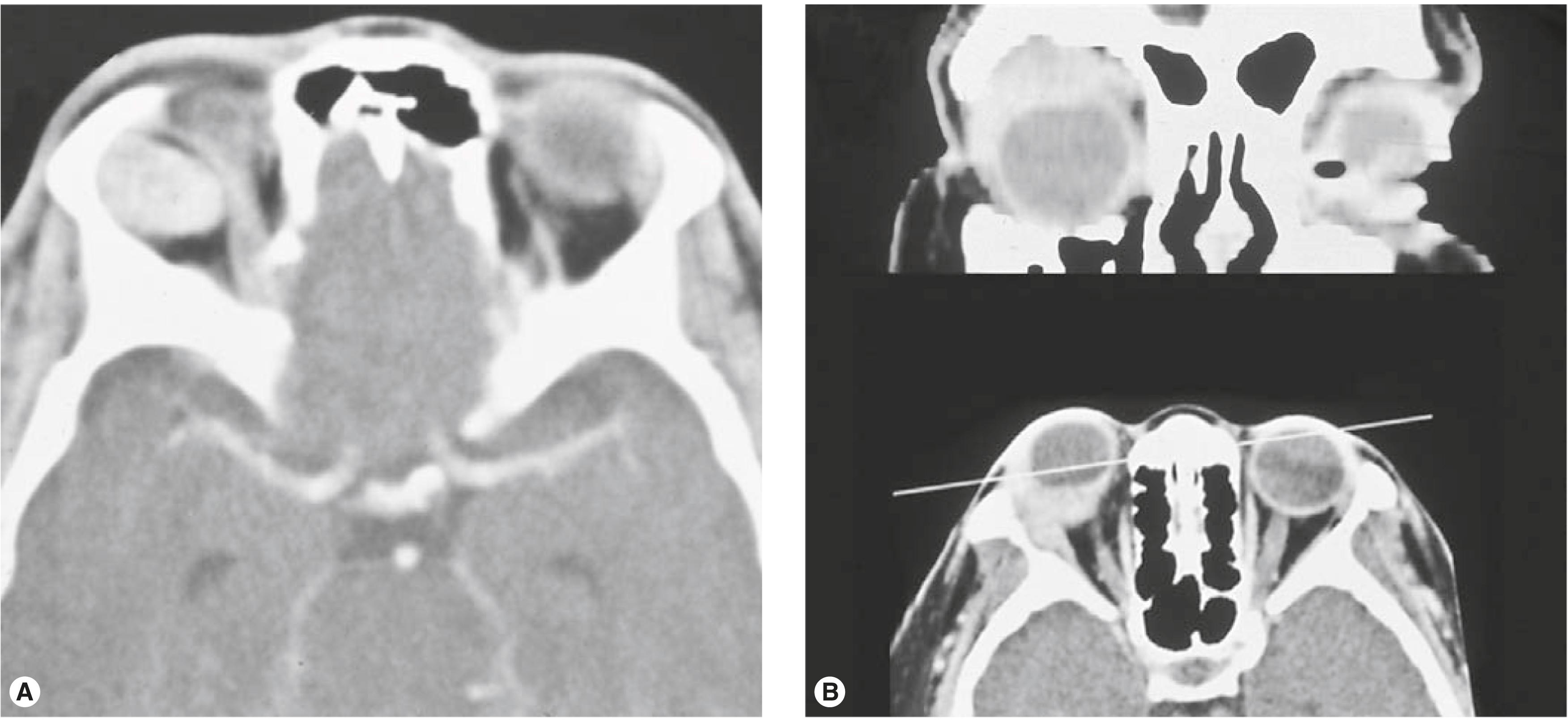 Figure 14.12, Orbital bone changes. ( A ) Fossa formation secondary to benign mixed tumor of the lacrimal gland. Note how the well-outlined mass pushes the bone away, creating a smooth fossa. ( B ) Bone erosion secondary to adenoid cystic carcinoma of the lacrimal gland. Note how the infiltrative mass creates an irregular change in the contour of the bone.