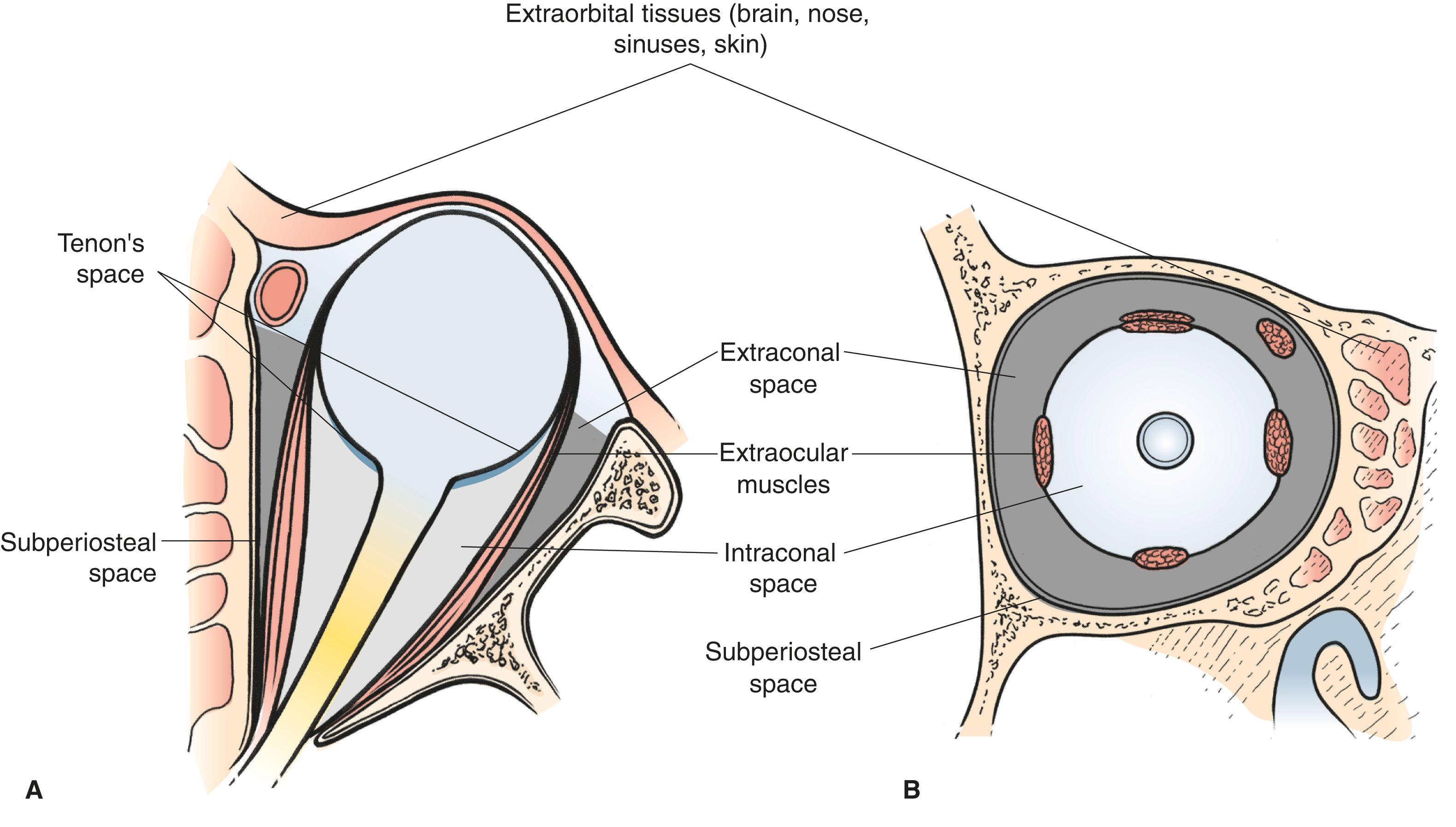 Figure 14.2, Axial ( A ) and coronal ( B ) views of the surgical spaces of the orbit: intraconal space (central surgical space), extraocular muscles, extraconal space (peripheral surgical space), subperiosteal space, Tenon’s space, extraorbital space (including periocular tissues, brain, nose, sinuses, bone, and surrounding soft tissues).