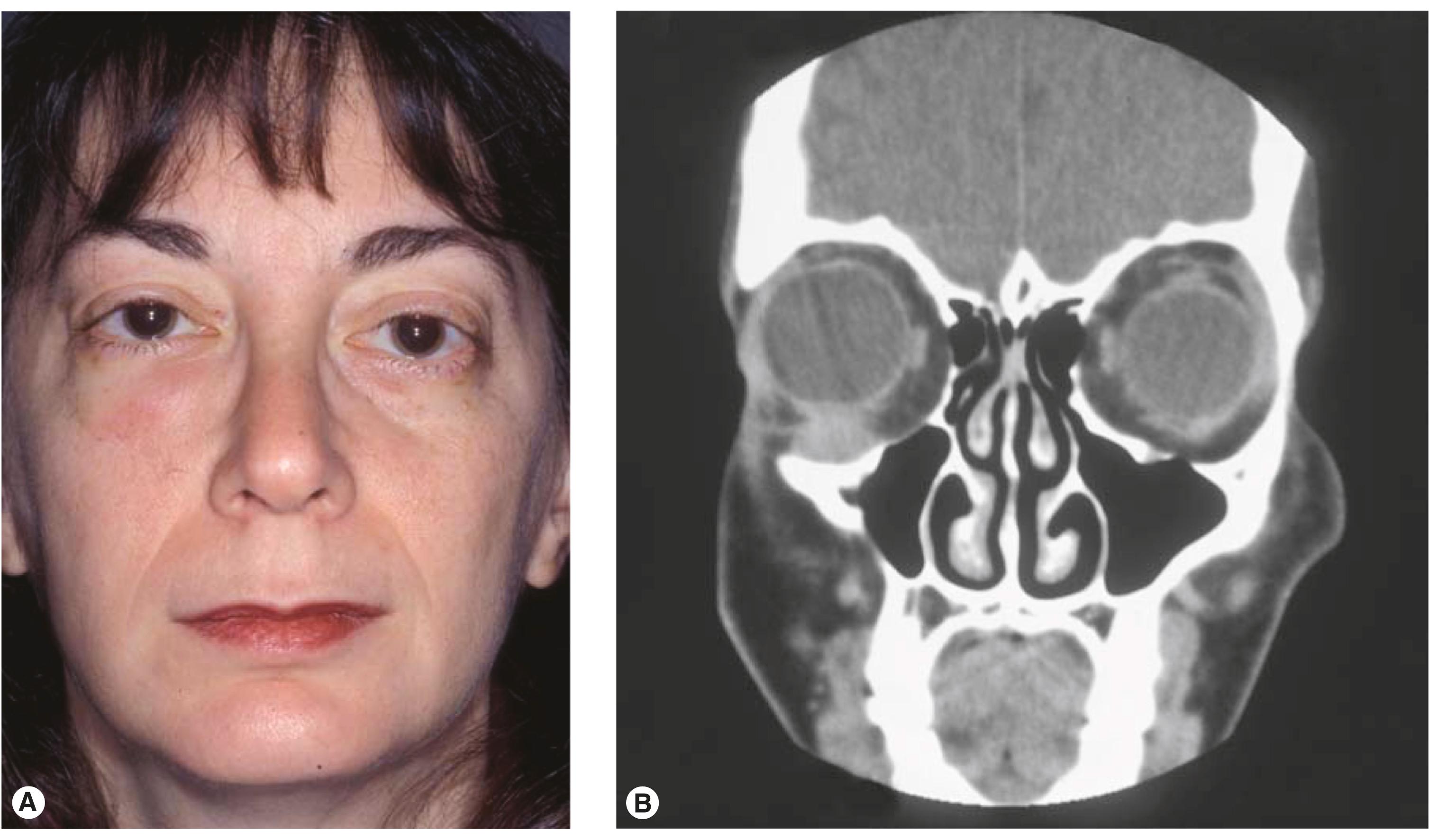 Figure 14.4, Globe displacement. ( A ) Superior displacement of the right eye. ( B ) CT scan shows a well-circumscribed mass, determined to be an unusual mesenchymal tumor after excisional biopsy.