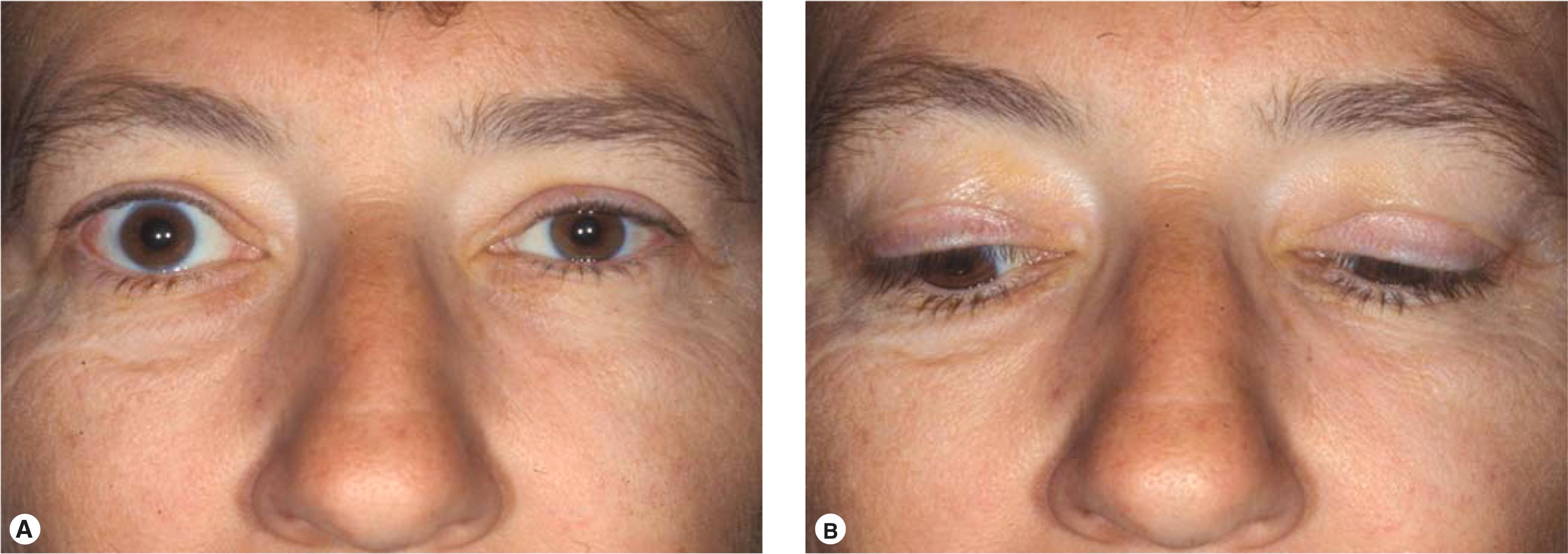 Figure 14.8, Periocular changes associated with thyroid orbitopathy. ( A ) Right upper lid retraction and temporal flare of the lateral upper eyelid, suggesting thyroid orbitopathy. ( B ) Lid lag on downgaze in the same patient.