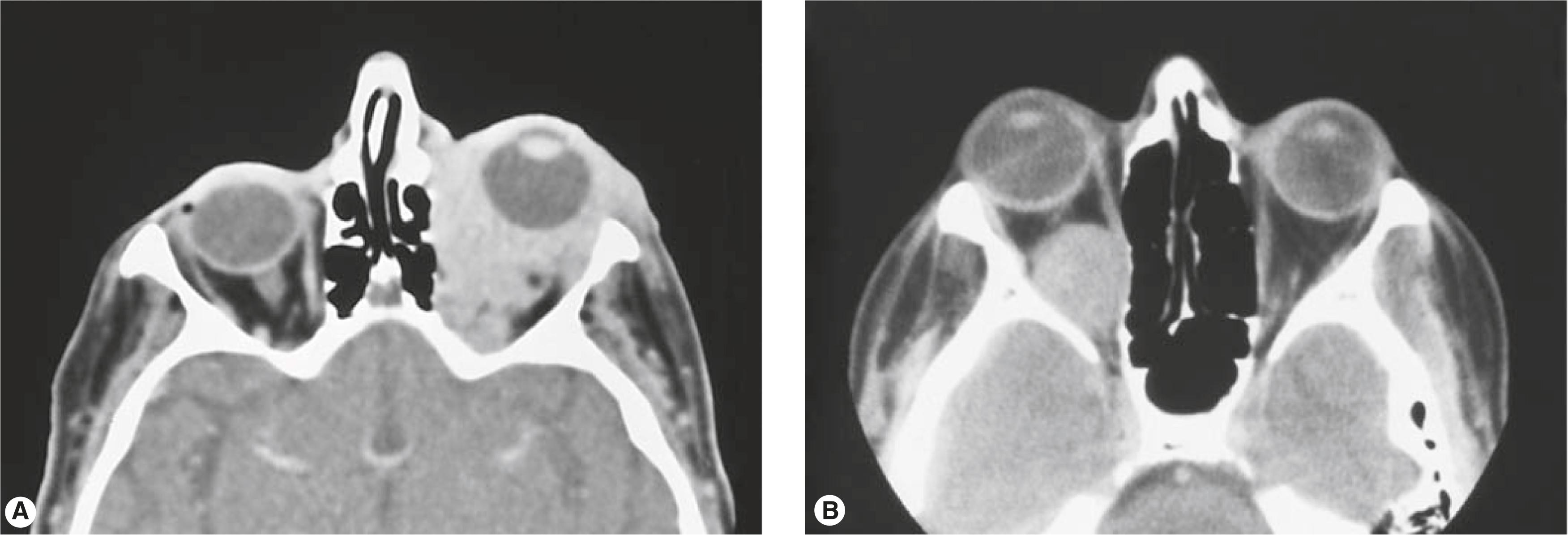 Figure 14.10, Infiltrative mass compared with well-circumscribed mass. ( A ) CT scan of infiltrative lesion shown to be a metastatic breast carcinoma. ( B ) CT scan of a well-circumscribed benign mass, a cavernous malformation. Note that the medial orbital wall is bowed outward but is not eroded.