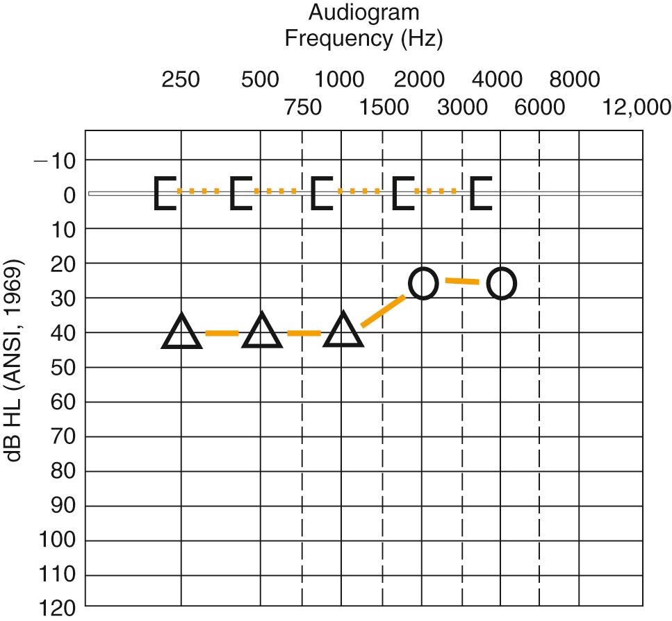 Fig. 134.2, Audiogram with a normal bone-conduction threshold and an elevated air-conduction threshold—an air-bone gap. ANSI, American National Standards Institute; dB HL, decibel hearing level.