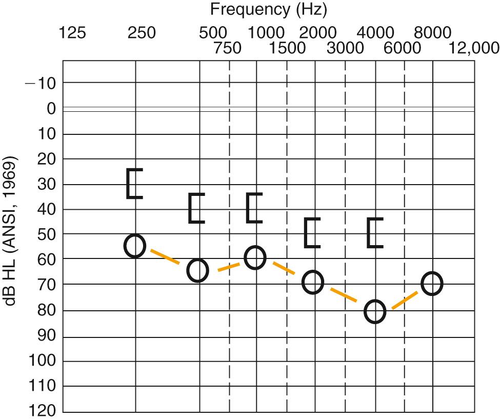 Fig. 134.4, Audiogram showing mixed hearing loss.