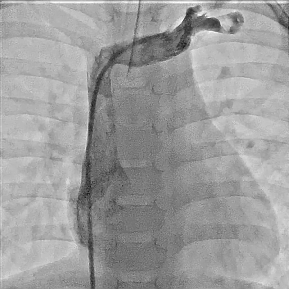 Fig. 17.1, Normal anatomy of the left innominate vein.