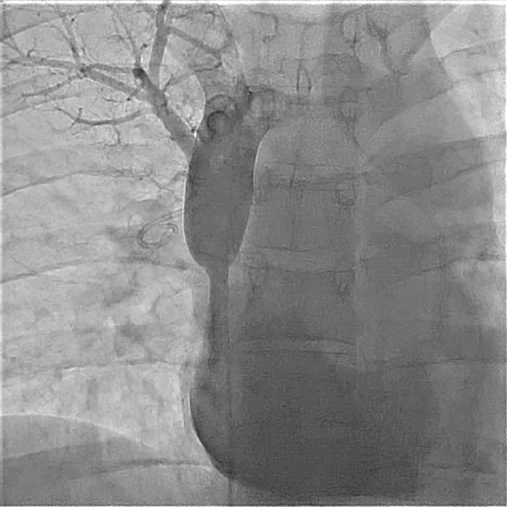 Fig. 17.2, Superior vena cava stenosis after operation for partial anomalous venous return.