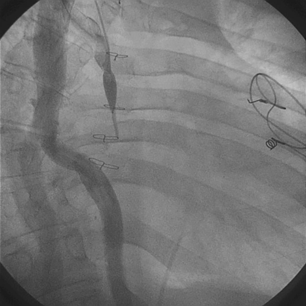 Fig. 17.3, Pop-off into the azygous due to an occluded superior vena cava.