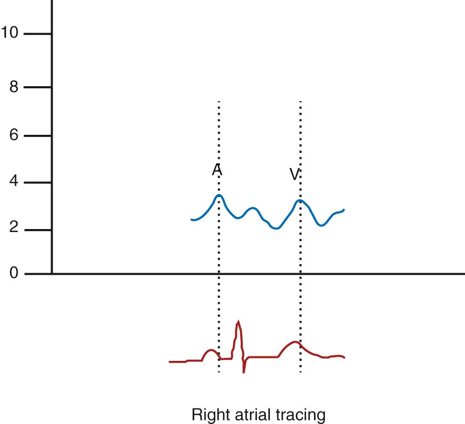 Fig. 17.4, Right atrial tracing with A wave and V wave measurement.