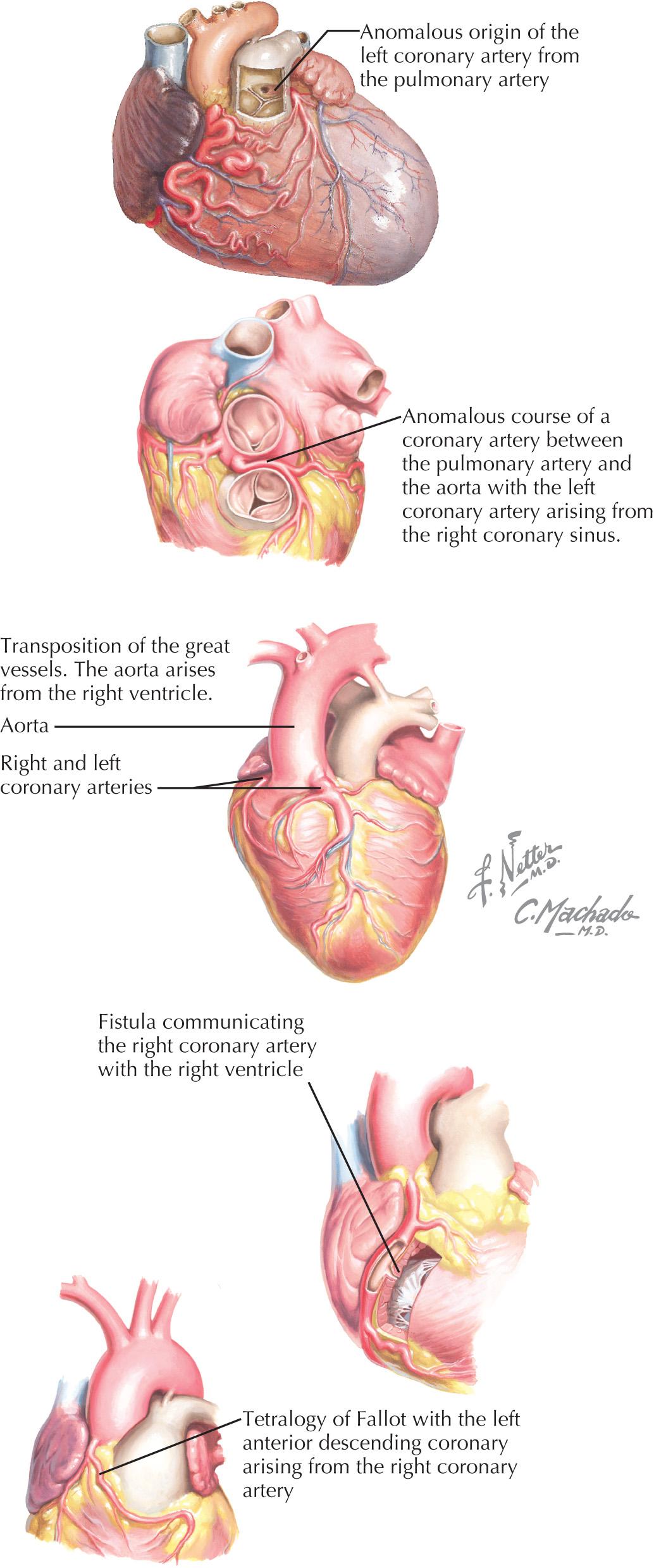 FIG 12.2, Congenital coronary artery anomalies.