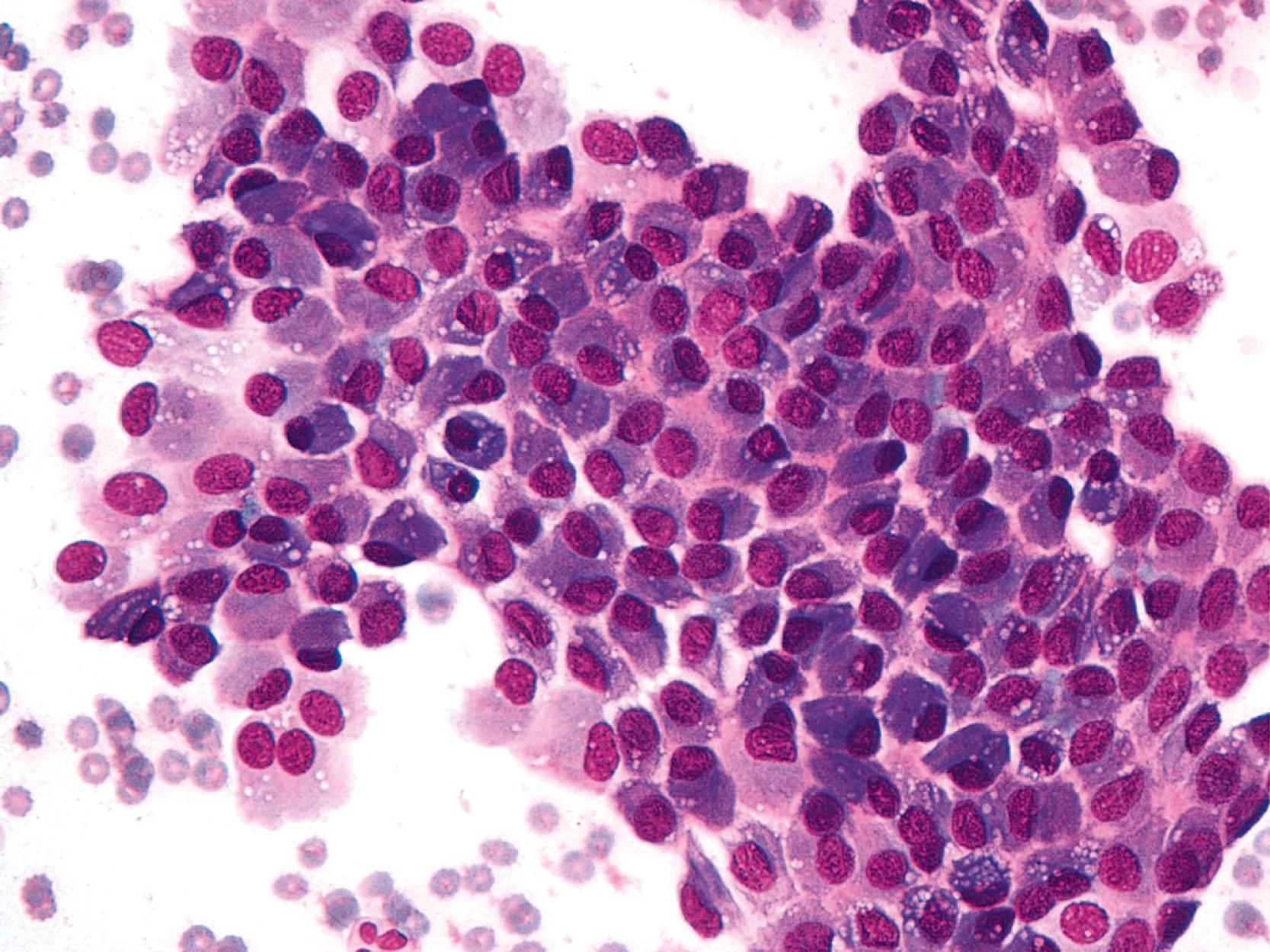 FIGURE 36.1, Mesothelial cells.