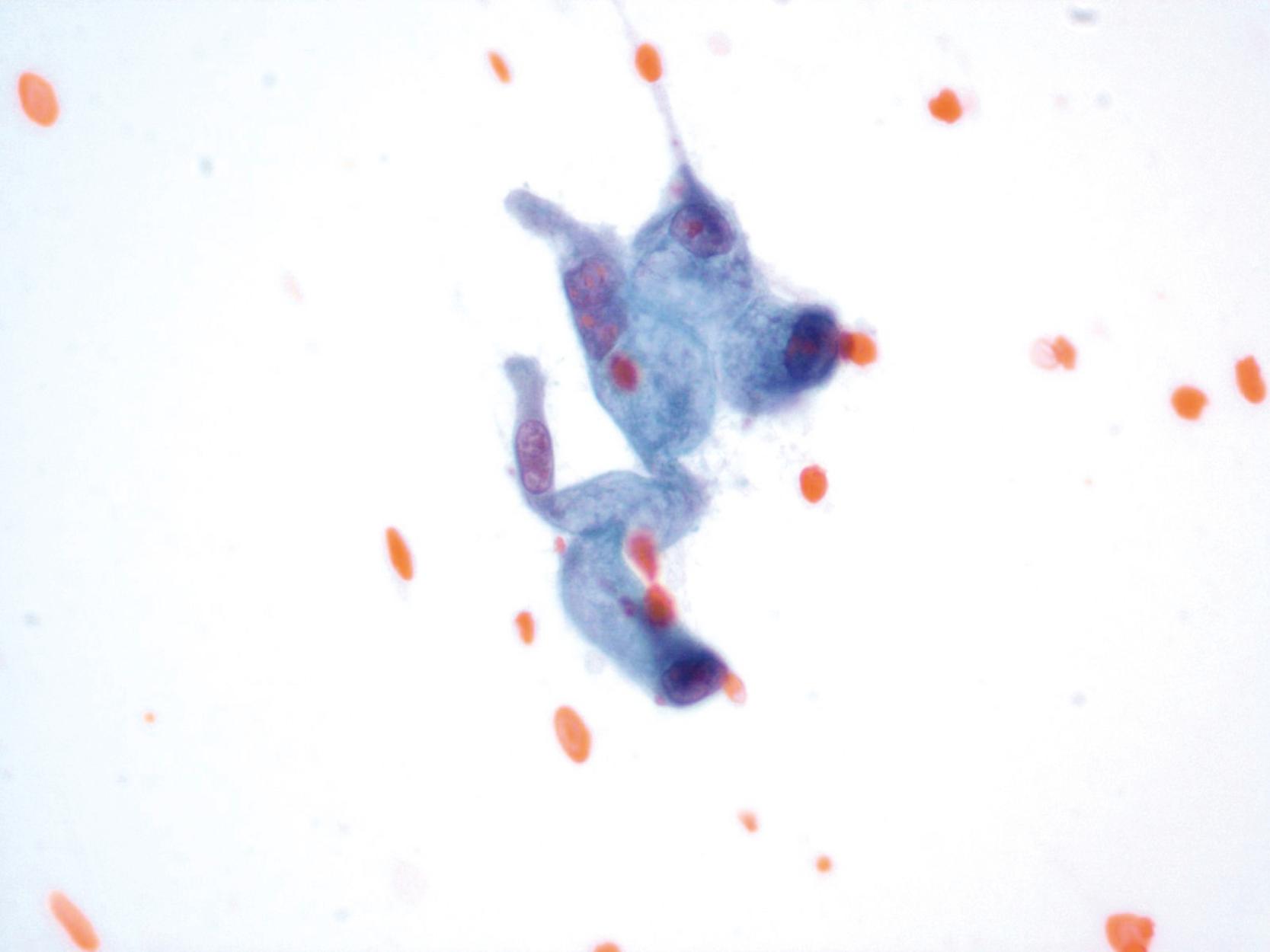 FIGURE 36.11, Atypical mucinous cells in a biliary tract brushing. The cells are columnar, with abundant cytoplasmic mucin. Nuclear atypia, such as subtle nuclear membrane irregularities, nucleoli, and abnormal parachromatin clearing are evident. Papanicolaou, 60×.