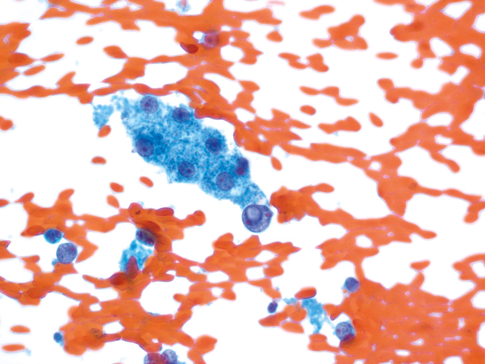 FIGURE 36.2, Benign hepatocytes with granular well-defined cytoplasm.