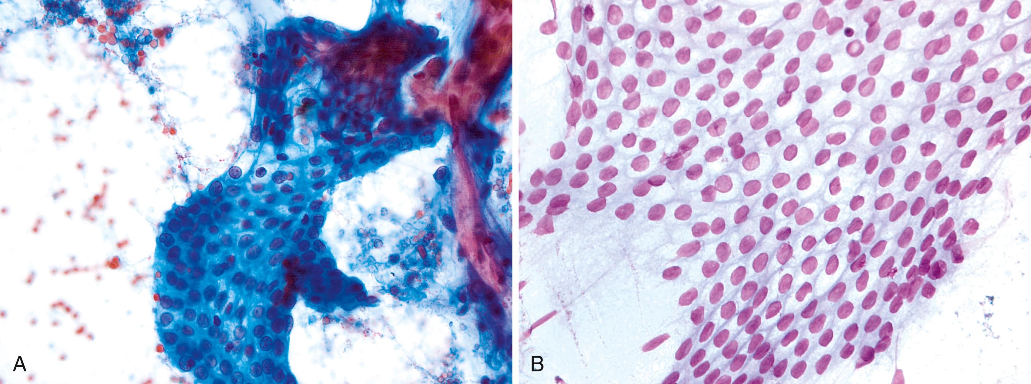 FIGURE 36.3, A, Gastric epithelium., Monolayered sheet with cells having well-defined cytoplasmic borders with mucin. The nuclei are round and fairly uniform in size. The group is associated with background mucin and single cells. Papanicolaou, 40×. B, Gastric epithelium. Large, flat monolayered group with well-defined cytoplasmic borders. The nuclei are relatively monomorphic, but do show subtle grooves. Diff-Quik, 40×.