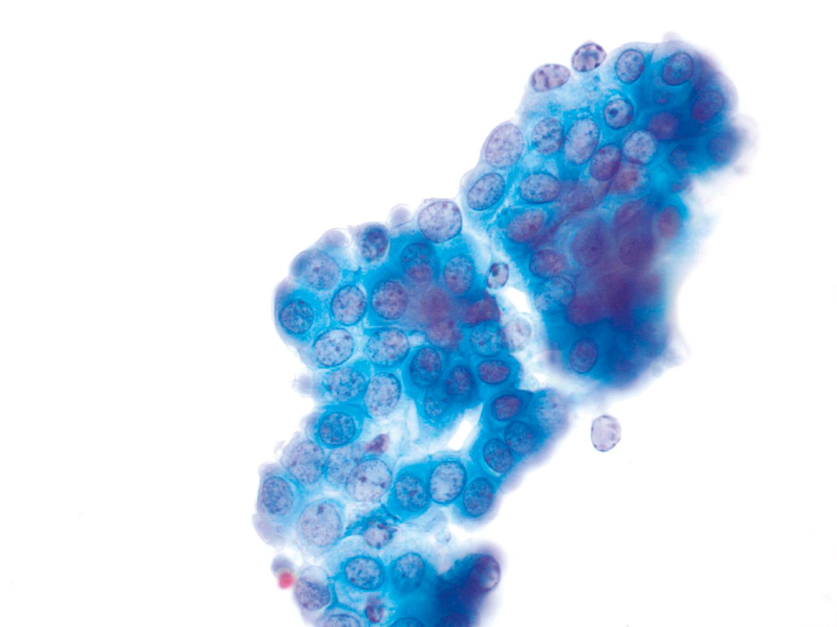 FIGURE 36.9, Group showing subtle nuclear enlargement and anisonucleosis. This reactive group retains a relatively monolayered appearance. Papanicolaou, 60×.