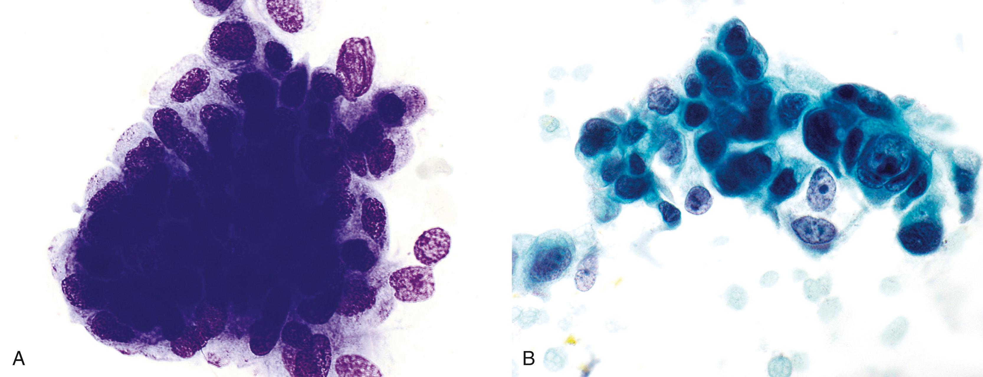 FIGURE 36.10, A, Low-grade biliary dysplasia. Cells with nuclear crowding, smooth nuclear membranes and overlapping. B, High-grade biliary dysplasia. The groups are 3-dimensional, with enlarged, crowded nuclei, and coarse chromatin.