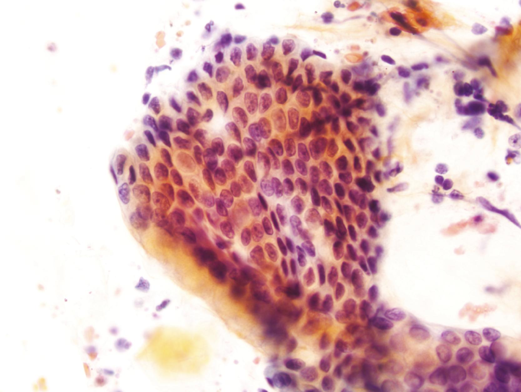 FIGURE 3.2, A sheet of benign gastric foveolar cells in a slightly distorted honeycomb pattern with evident columnar cells in palisading arrangement at the periphery is seen in a gastric brushing specimen. The presence of small nucleoli in some of the cells may indicate reactive change (Papanicolaou stain).