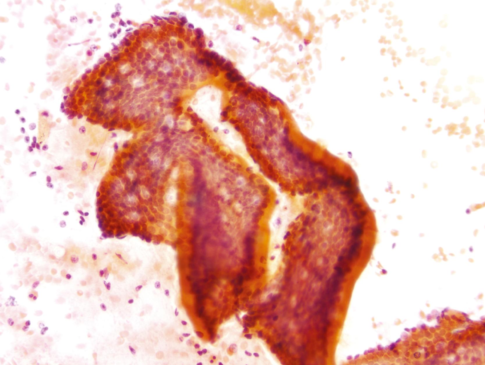 FIGURE 3.3, A complex sheet of small intestinal–type epithelium is seen in a duodenal brushing specimen. It has a Swiss cheese appearance, with the “holes” representing either goblet cells or gland openings of the crypts (Papanicolaou stain).