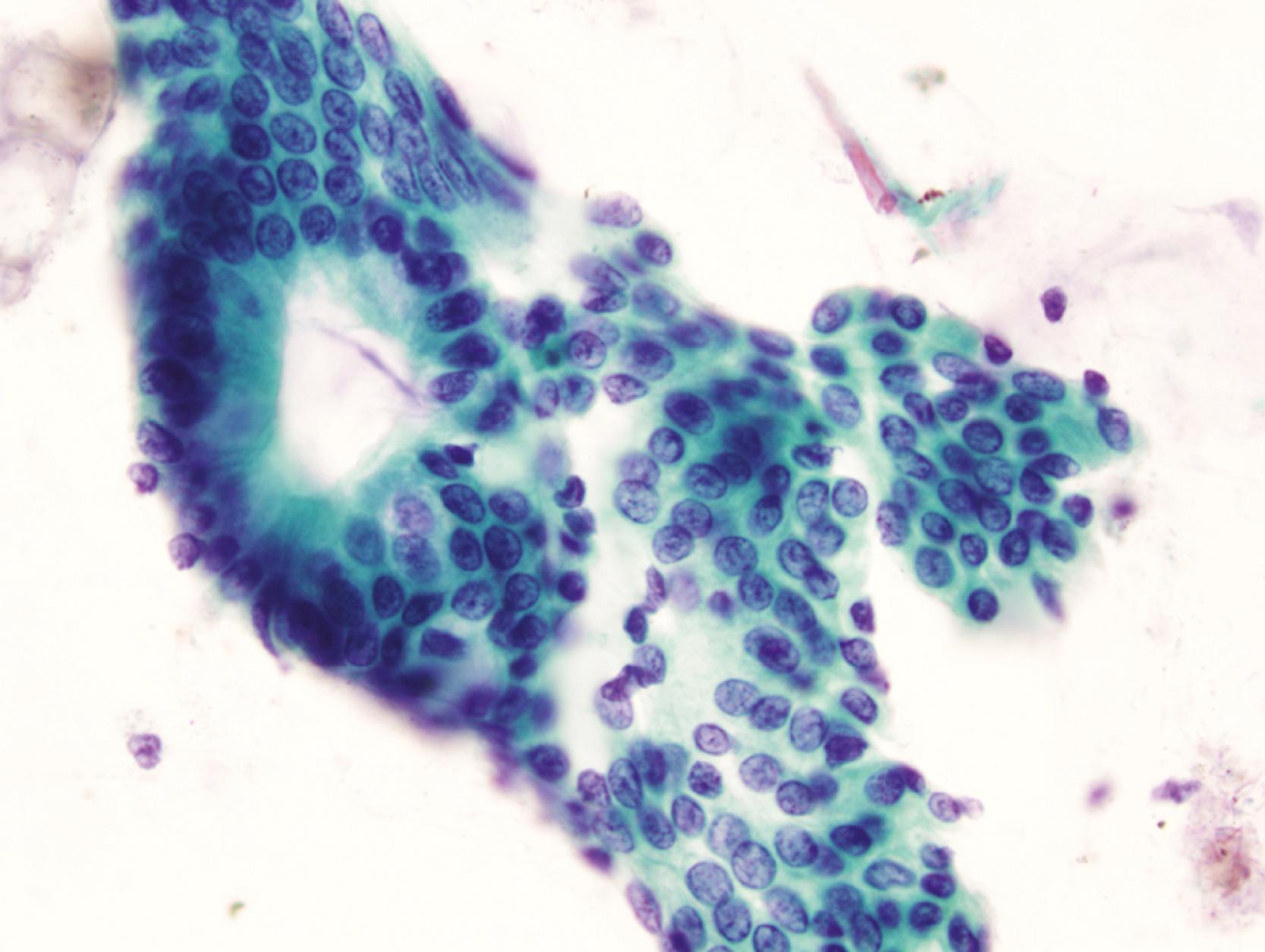 FIGURE 3.4, A sheet of normal colonic columnar epithelial cells is present in a colonic brushing specimen. A gland opening is seen in the left half of the field (Papanicolaou stain).