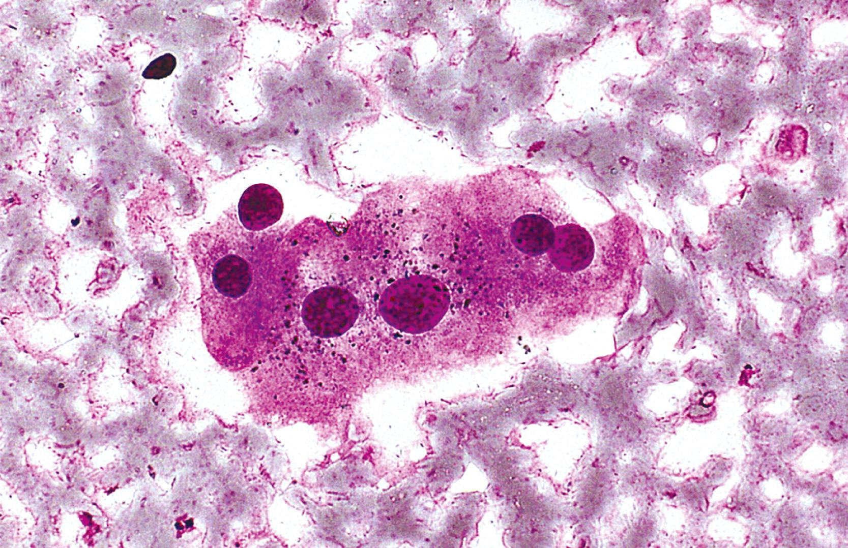 FIGURE 46.3, Lipofuscin pigment appears as nonrefractile, black granules located in the perinuclear cytoplasm of nonneoplastic hepatocytes (May-Grünwald-Giemsa stain).