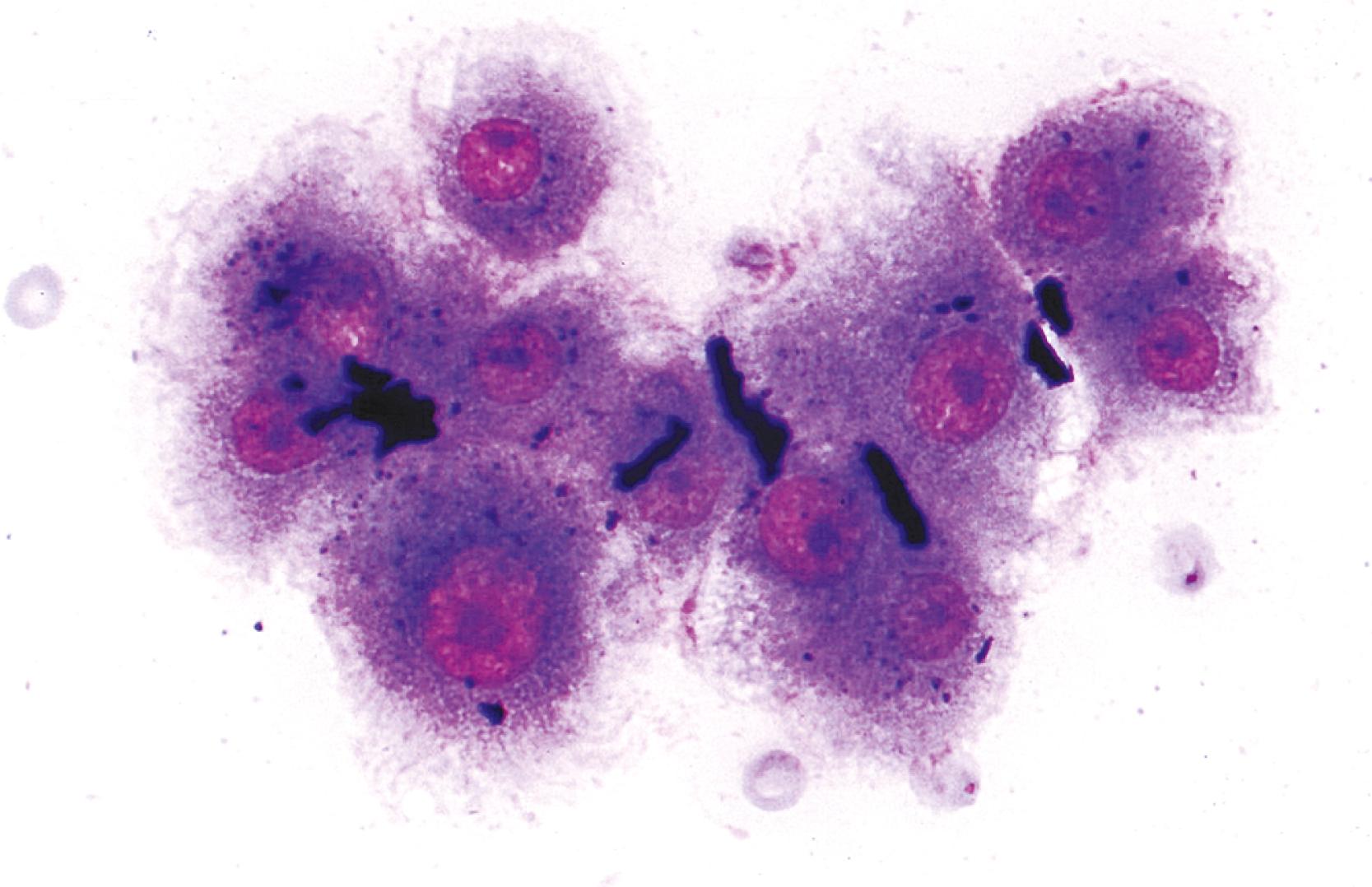 FIGURE 46.4, Bile pigment is seen as purplish-black, ropey strands within bile canaliculi and a few black droplets within the cytoplasm of nonneoplastic hepatocytes in a patient with cholestasis (May-Grünwald-Giemsa stain).