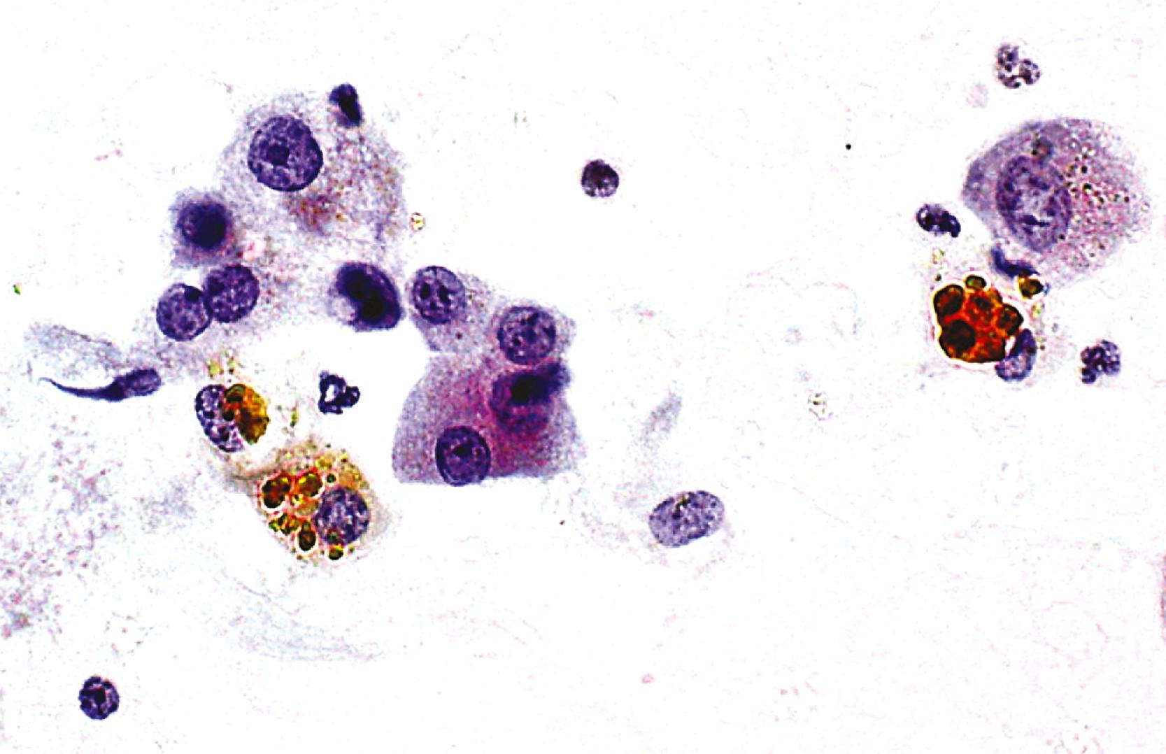 FIGURE 46.5, Hemosiderin (iron) pigment appears as coarse, golden-brown, refractile granules within the cytoplasm of nonneoplastic hepatocytes (Papanicolaou stain).