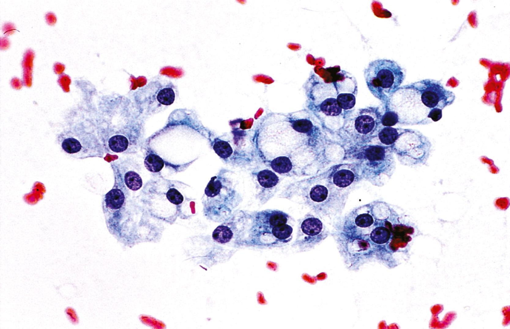 FIGURE 46.6, Macrovesicular steatosis.