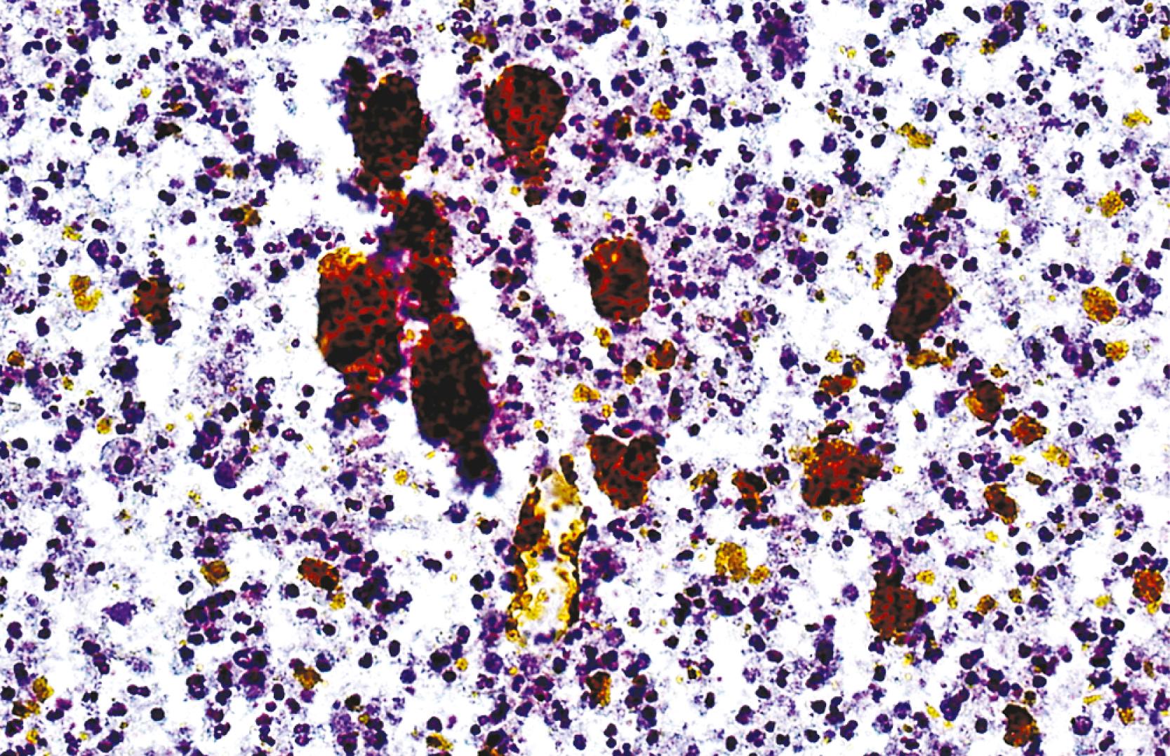 FIGURE 46.7, Pyogenic abscess.