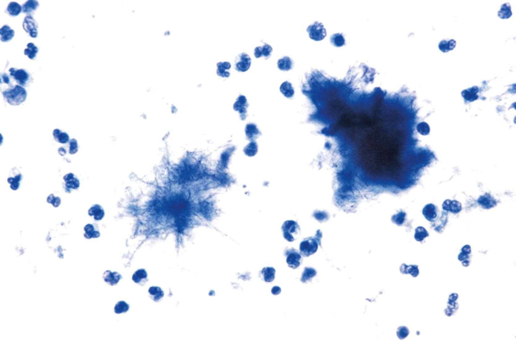 FIGURE 46.8, Abscess caused by Actinomyces .