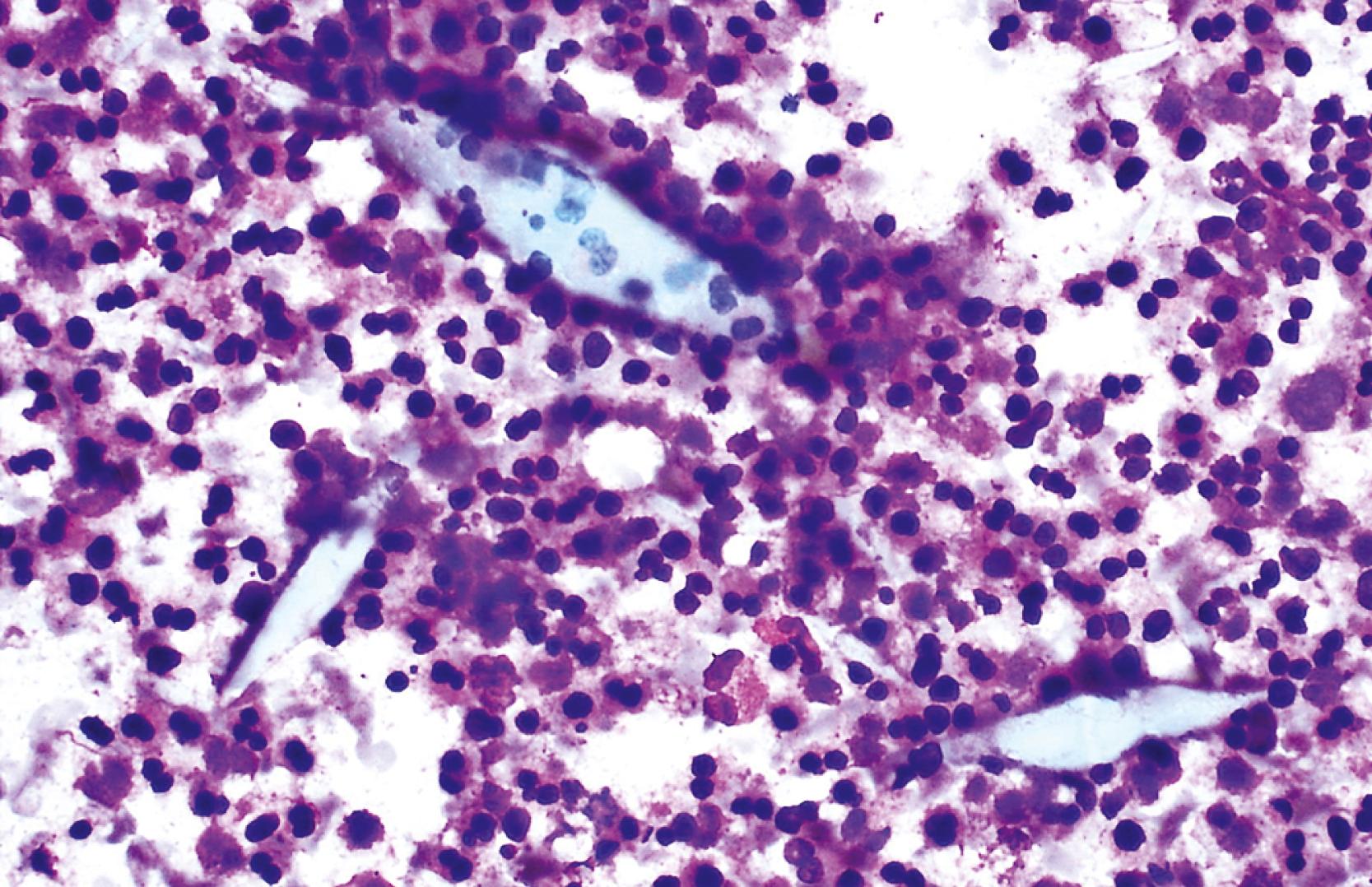 FIGURE 46.9, Necrotizing eosinophilic granuloma.