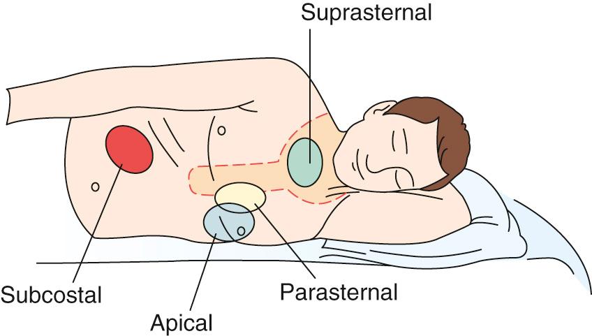 FIGURE 55-1, Standard acoustic windows for transthoracic echocardiography. Parasternal and apical windows are obtained with the patient in a left lateral position. The subcostal window is obtained with the patient supine and legs flexed, to relax the abdominal wall. The suprasternal notch window is obtained with the patient's head tilted to the side to aid transducer placement.