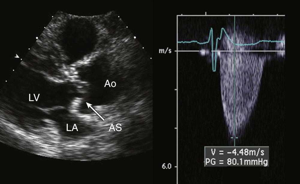 FIGURE 55-12, Severe aortic stenosis (AS), with thickened, calcified aortic valve leaflets on the parasternal long axis view. On continuous Doppler imaging across the aortic valve, the peak velocity (V) is 4.5 m/s, corresponding to a peak gradient (PG) of 80 mm Hg, using the simplified Bernoulli equation. Ao, Aorta; LA, left atrium; LV, left ventricle.