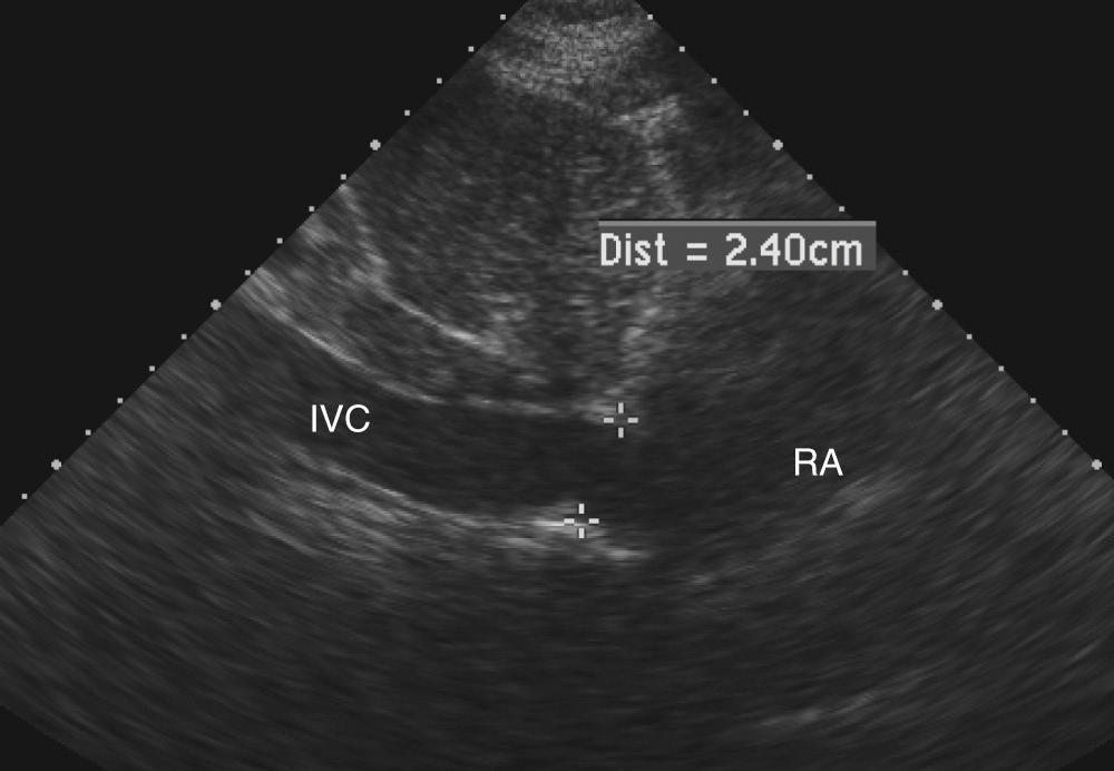 FIGURE 55-14, Inferior vena cava (IVC) diameter at rest in a patient with mildly increased right atrial pressures. RA, Right atrium.