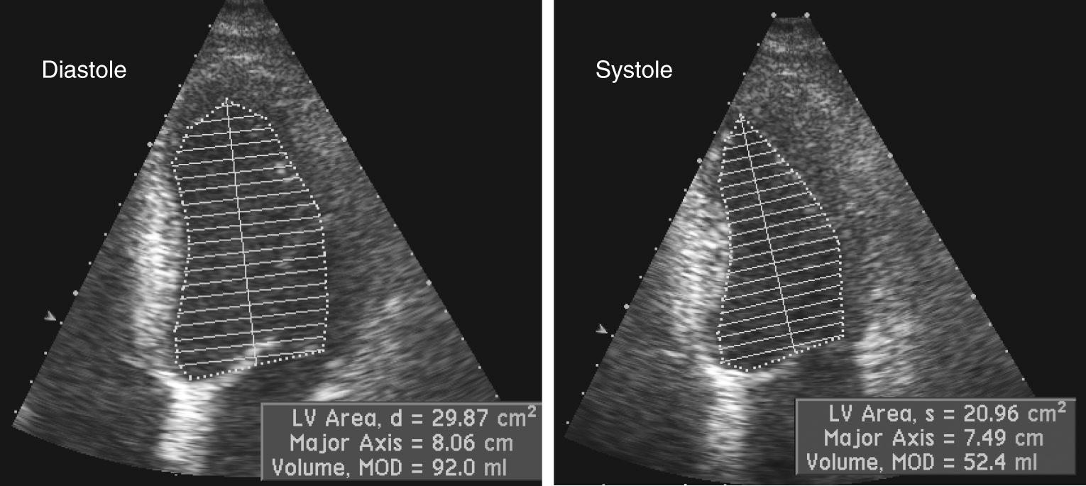 FIGURE 55-15, Endocardial border tracings of the left ventricle (LV) from the apical four-chamber view during diastole and systole are used to calculate LV volumes. Using concordant LV volume calculations from the apical two-chamber view, ejection fraction is calculated using the apical biplane method of disks algorithm. Volume, MOD, Calculated LV volume.