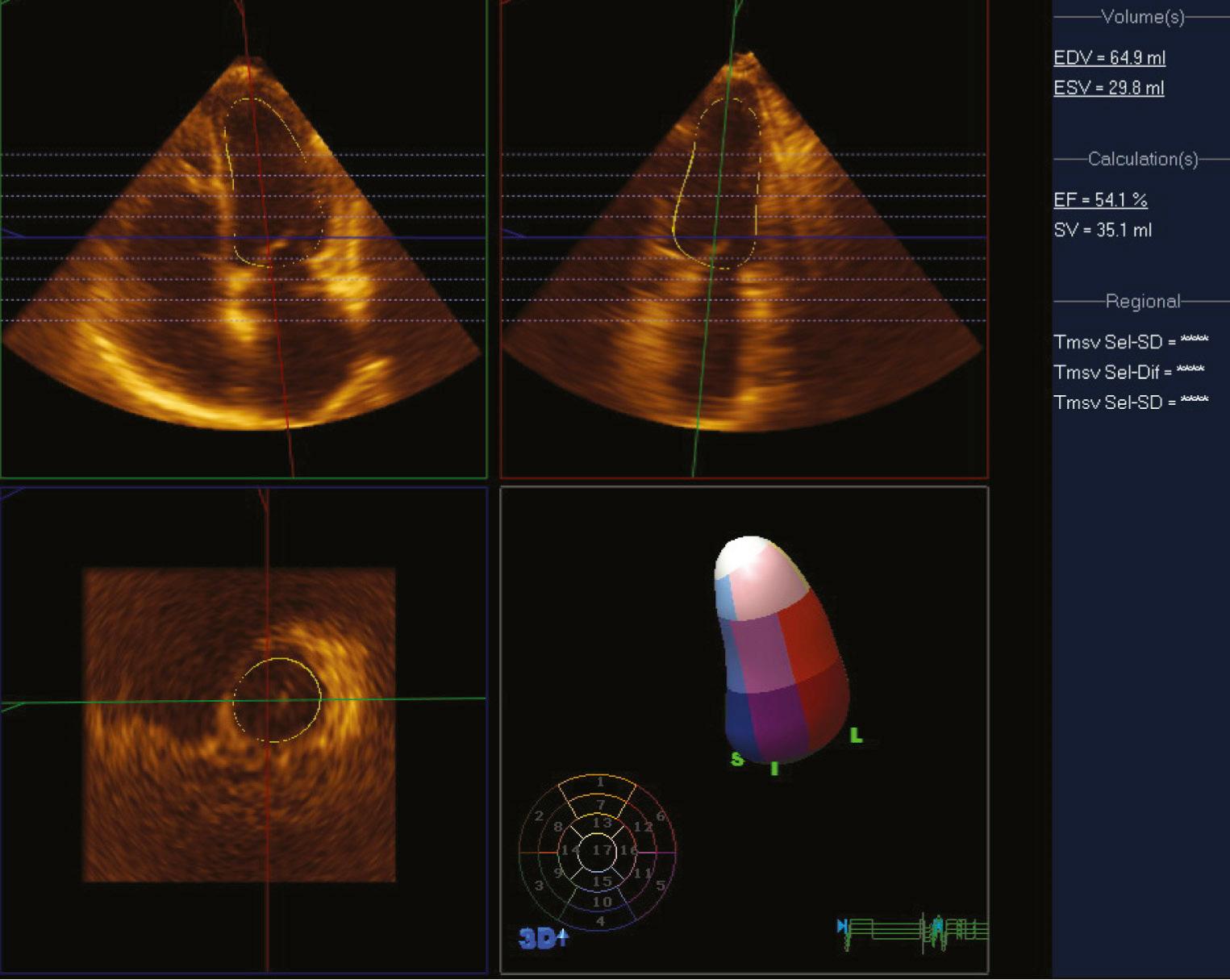 FIGURE 55-16, Three-dimensional volume data set of the left ventricle (LV) with an end-diastolic volume (EDV) of 64.9 mL, an end-systolic volume (ESV) of 29.8 mL, a stroke volume (SV) of 35.1 mL, and an LV ejection fraction of 54.1%.