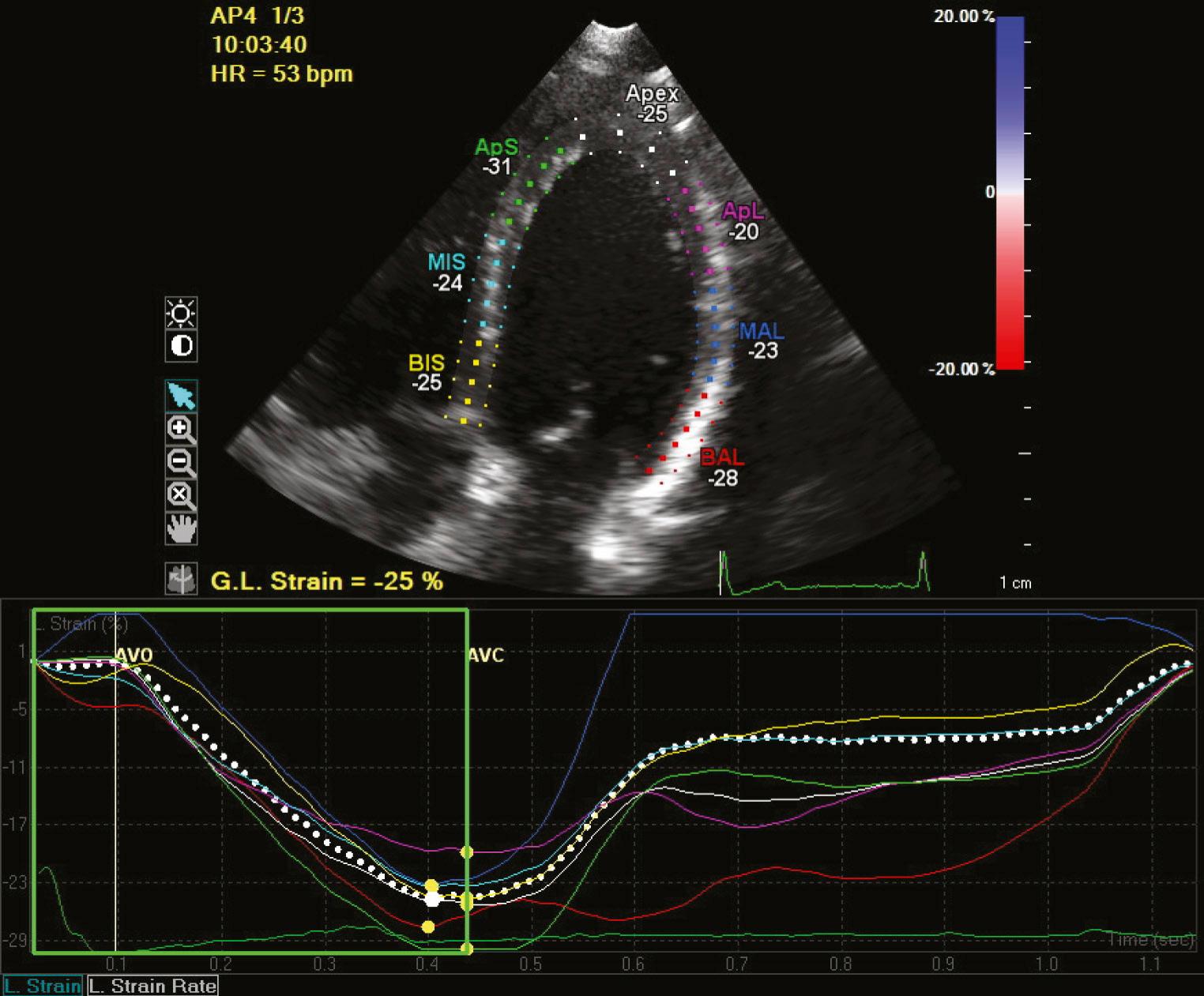 FIGURE 55-17, Strain imaging from the apical four-chamber view. Strain measurement from each segment is color coded and displayed on the graph below the imaging against time. A composite “global” longitudinal strain measurement is provided in the lower left hand portion of the image (G.L. strain = −25%). Normal longitudinal strain measurement is less than −20. All segmental and global strain measurements are normal in this patient.