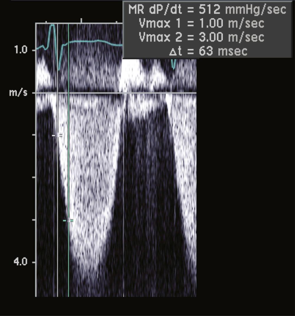 FIGURE 55-18, Continuous wave Doppler tracings of the mitral regurgitant jet showing a decreased rate of rise to the peak LV cavity pressure during early systole in a patient with severely reduced LV systolic function and ejection fraction of 25% (dP/dt). With normal systolic function, the change in rate of rise in pressure over time should be greater than 1000 mm Hg/sec. Δt, Change in time; Vmax 1, first velocity measured; Vmax 2, second velocity measured.