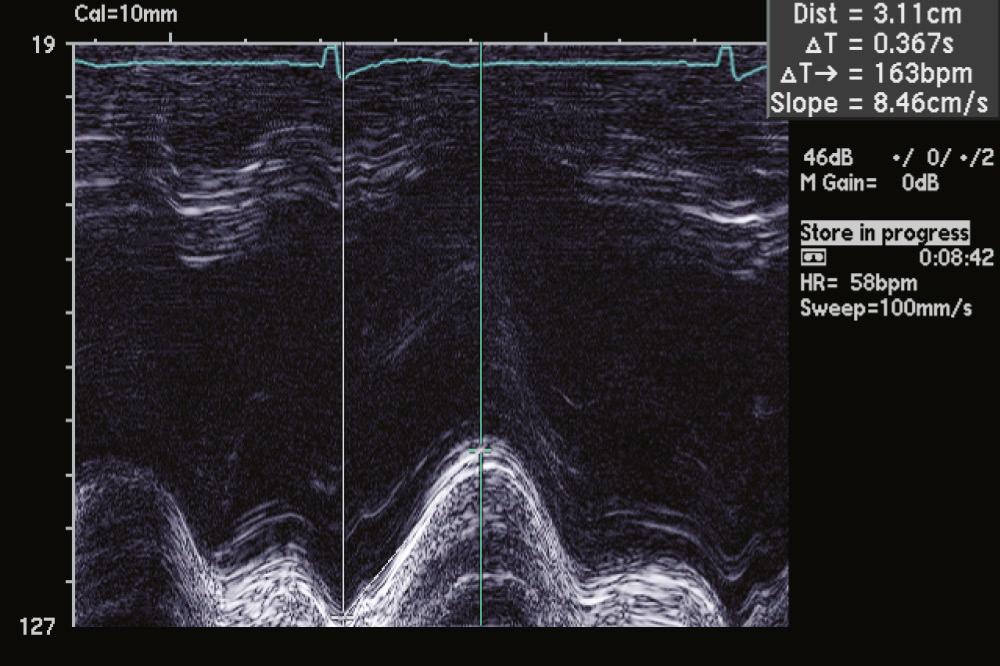 FIGURE 55-19, M-mode tracing of the tricuspid annular motion against the time dimension. Vertical distance between the lowest point and greatest systolic motion is measured. This patient has a distance measurement of 3.1 cm (greater than 1.8 cm suggests normal systolic function). ΔT, Change in time.