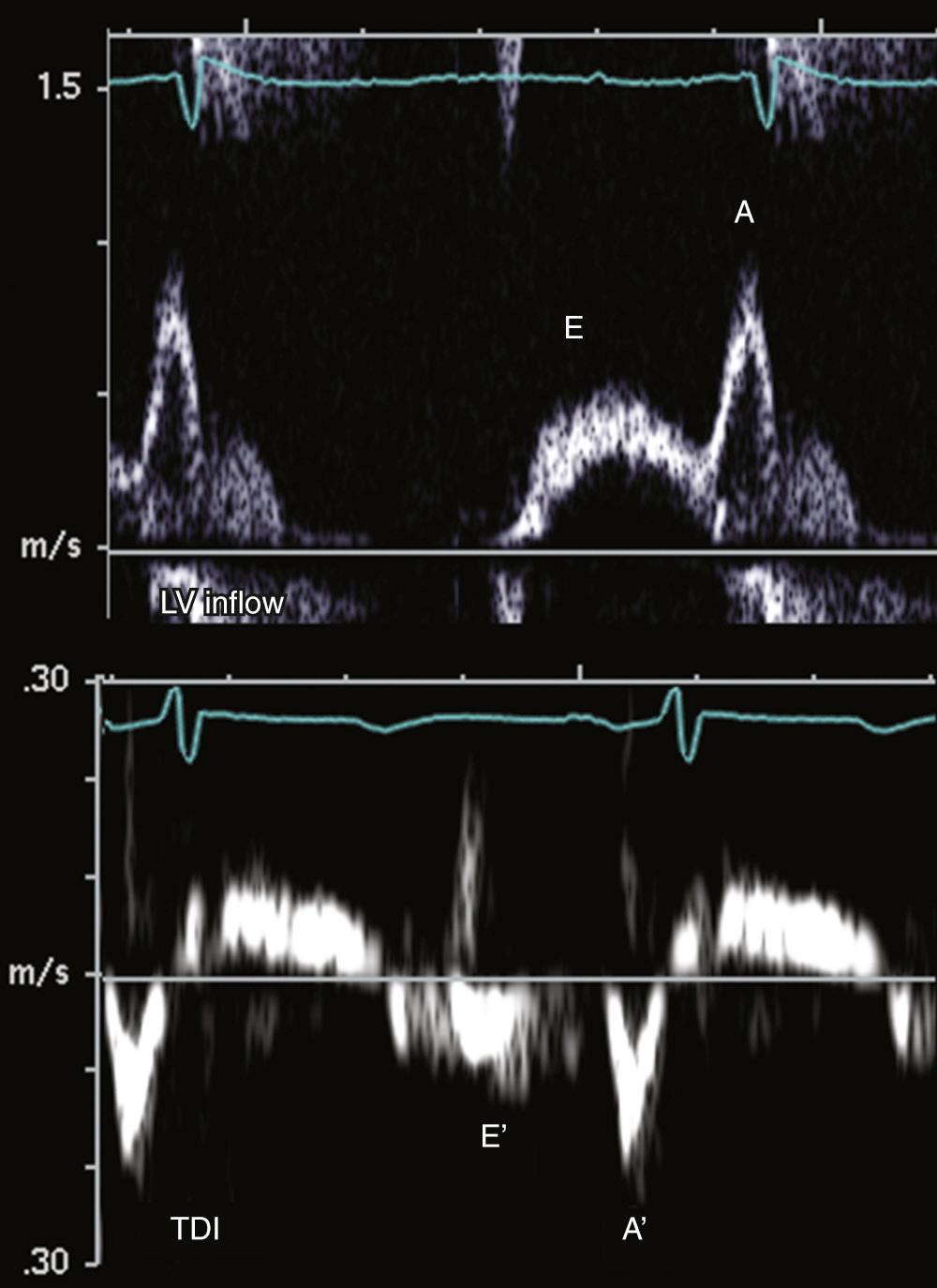 FIGURE 55-20, Doppler indices for mild diastolic function. With impaired ventricular relaxation, peak early mitral inflow velocity is decreased. Increased reliance on atrial contribution to ventricular filling leads to reversal of the E : A ratio on the left ventricular (LV) inflow tracing. A ratio of LV inflow E wave to tissue Doppler velocity (TDI) E' wave (E:E' ratio) less than 8 implies normal left atrial pressure. In this case, E:E' = 0.6/0.1 = 6.