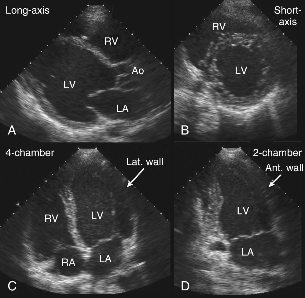 FIGURE 55-2, A, Parasternal long axis view in a patient with dilated cardiomyopathy shows the anteroseptum and posterior wall of the left ventricle. B, Parasternal short axis view in a patient shows a cross-section through the mid-portion of ventricles. C, Apical four-chamber view shows the lateral (Lat. wall) and inferoseptal walls of the left ventricle (LV) and the free wall of the right ventricle. D, Apical two-chamber view shows anterior (Ant. wall) and inferior walls of the LV.