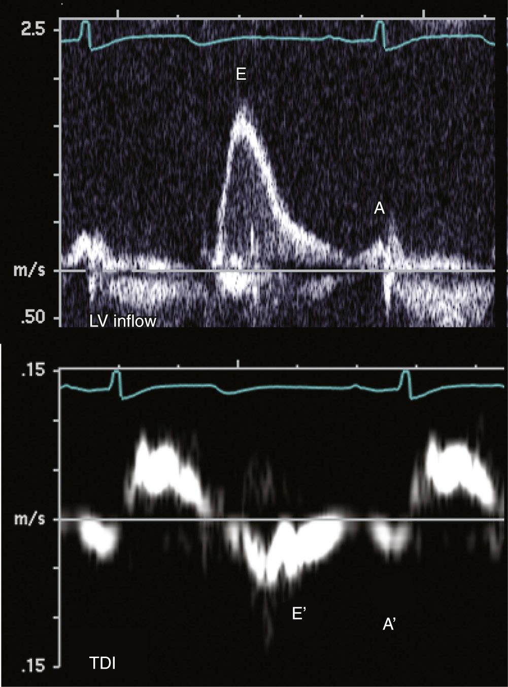 FIGURE 55-21, With advanced diastolic dysfunction (restrictive filling), there is decreased left ventricle (LV) compliance. High left atrial pressures drive transmitral filling with a higher, early peaked E wave and E : A ratio greater than 2. A ratio of LV inflow E wave to tissue Doppler velocity (TDI) E' wave (E:E' ratio) greater than 15 implies elevated left atrial pressure. In this case, E:E' = 1.7/0.07 = 24.