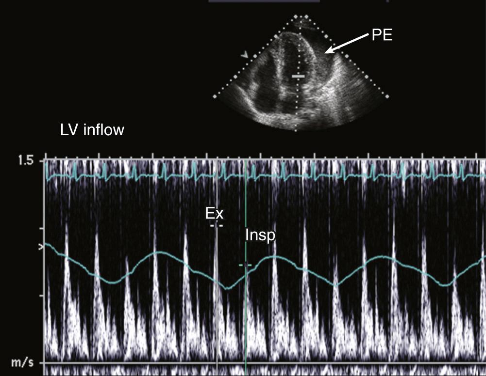 FIGURE 55-22, Pericardial effusion (PE) in a patient with dyspnea. The transmitral pulsed Doppler tracing demonstrates respiratory variation in flow. Ex, Expiration; Insp, inspiration.